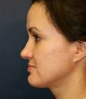 Rhinoplasty San Diego Case 24 - before