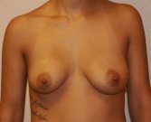 Breast Augmentation San Diego Case 47 - before